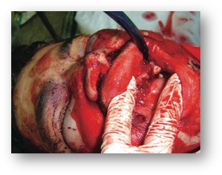 External Airway Obstruction