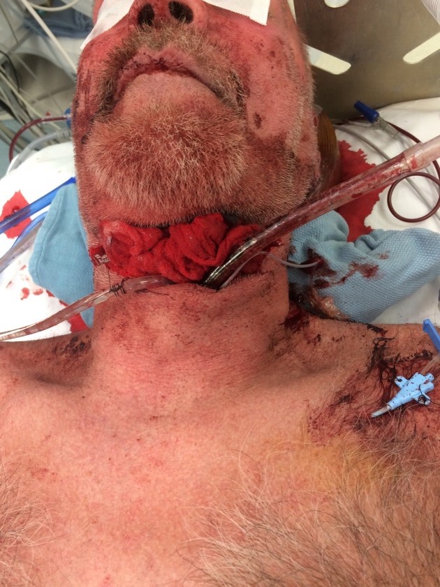 Internal Airway Obstruction